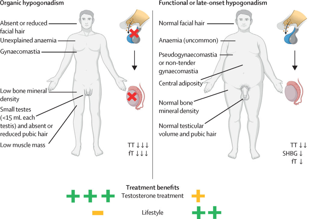 Male Hypogonadism