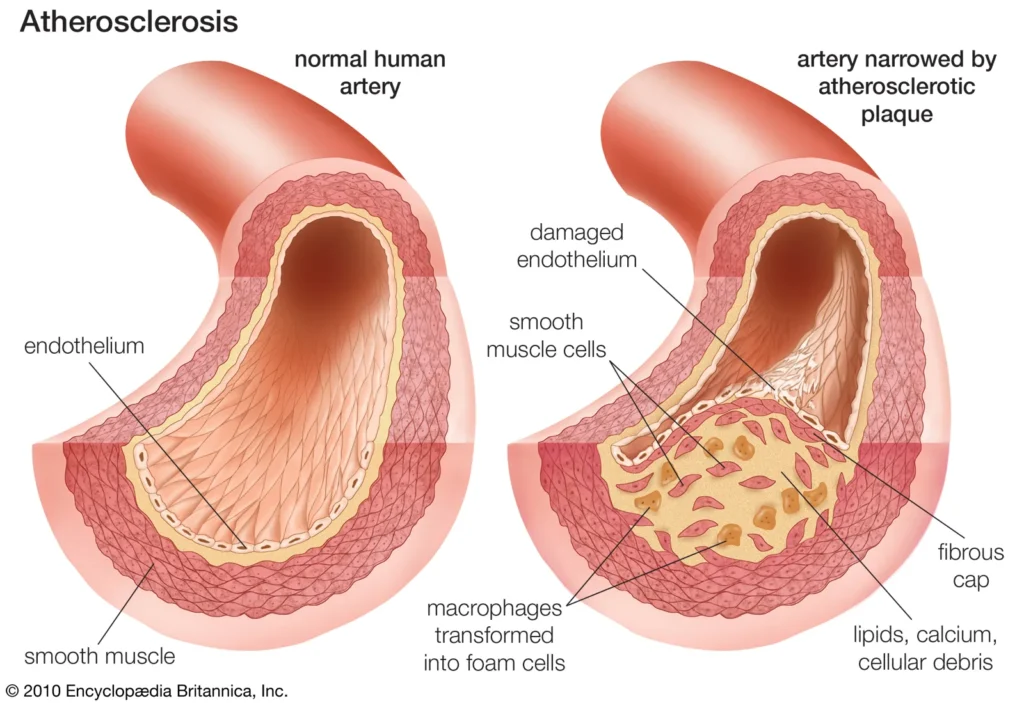 Atherosclerosis-blood vessels-1st Optimal