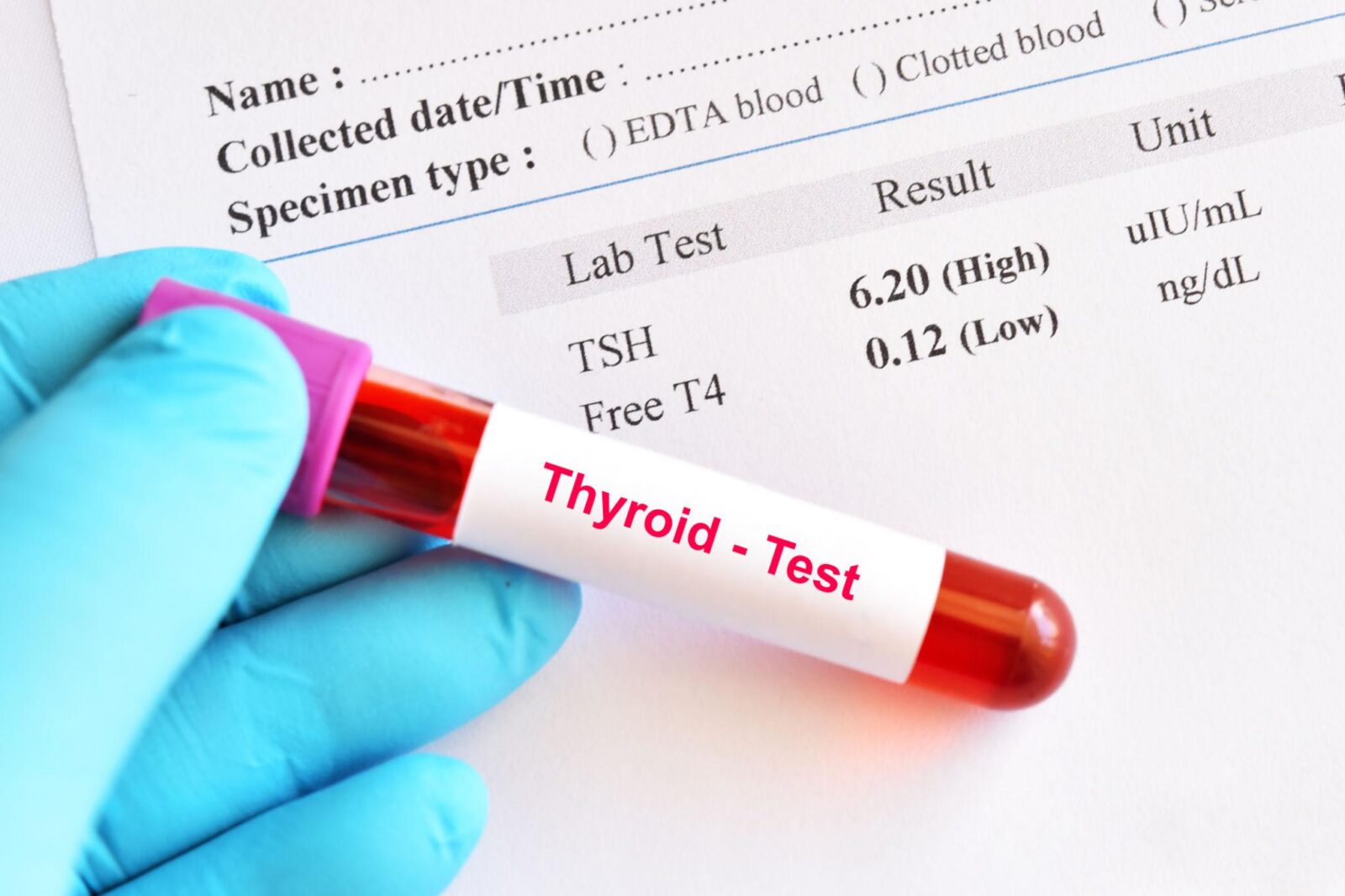 Normal TSH but Still Tired: What Else Should Be Checked?
